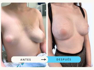 Aumento de pecho antes y después - 875384