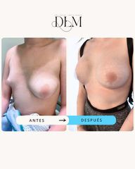 Aumento de pecho