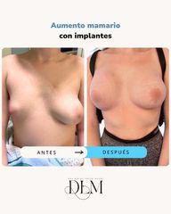 Aumento de pecho