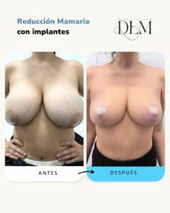 Mastopexia