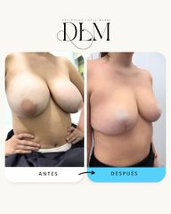 Mastopexia