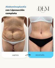 Abdominoplastia