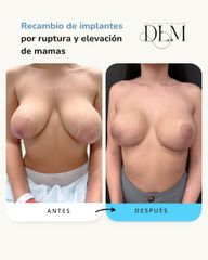Aumento de pecho