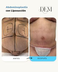 Abdominoplastia