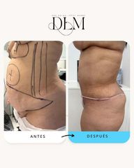 Abdominoplastia