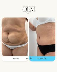 Abdominoplastia