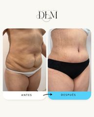 Abdominoplastia