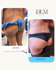 Combinación de abdominoplastia y lipotransferencia