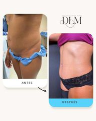 Combinación de abdominoplastia y lipotransferencia