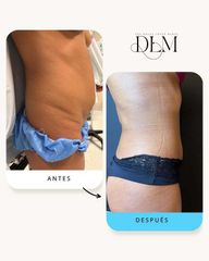 combinación de abdominoplastia y lipotransferencia