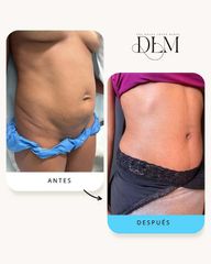 combinación de abdominoplastia y lipotransferencia