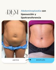 combinación de abdominoplastia y lipotransferencia