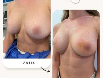 Reducción senos antes y después - 878127