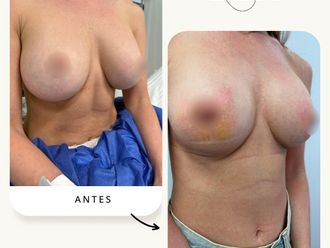 Reducción senos antes y después - 878128
