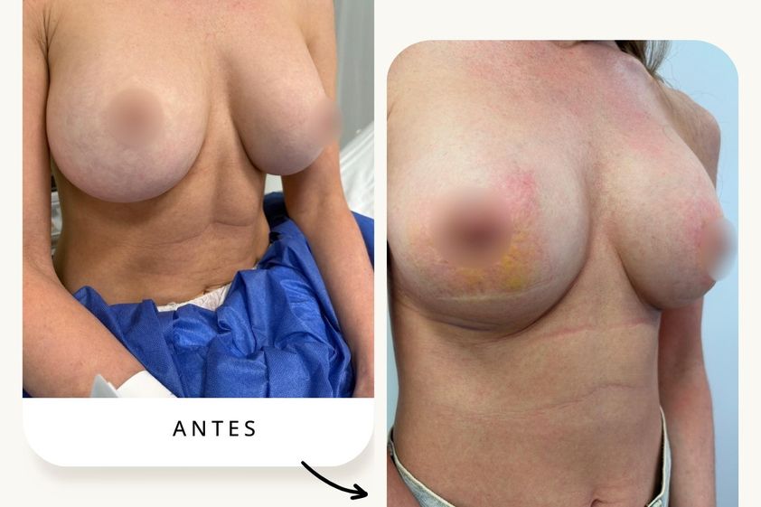 Reducción senos antes y después - 878128