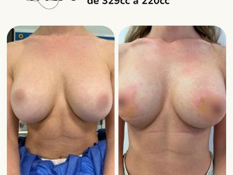 Reducción senos antes y después - 878129