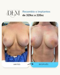 Reducción de senos