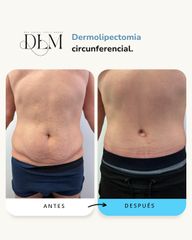Dermolipectomia