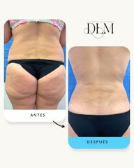 Abdominoplastia con Liposucción