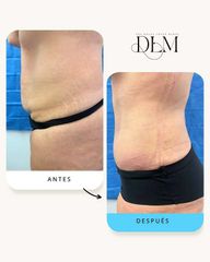 Abdominoplastia con Liposucción