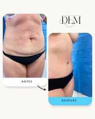 Abdominoplastia con Liposucción