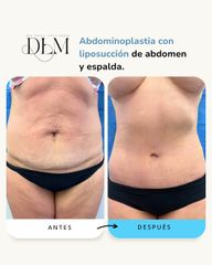 Abdominoplastia con Liposucción