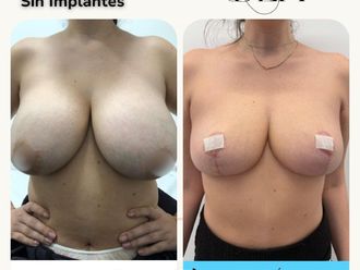 Reducción senos antes y después - 880372