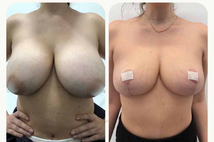 Reducción senos antes y después - 880372