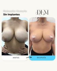 Dra Lopez Munné Reducción de pecho