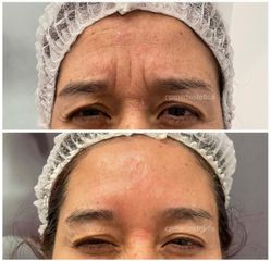 Rellenos faciales - Dra. Cristina Palacios