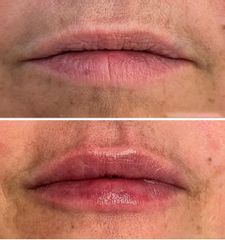 Aumento labios - Dra. Cristina Palacios