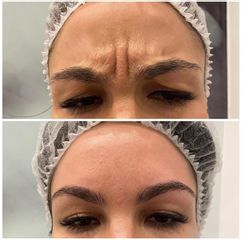Rellenos faciales - Dra. Cristina Palacios