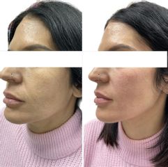 Rellenos faciales - Dra. Cristina Palacios