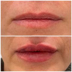 Aumento labios - Dra. Cristina Palacios