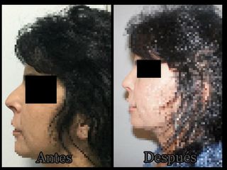 Antes y después Rinoplastia - Dr Francisco Ortiz Bish