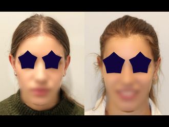 Otoplastia - 642938