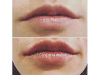 Antes y después Aumento de labios - Dr Francisco Ortiz Bish