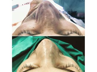 Antes y después Rinoplastia - Dr Francisco Ortiz Bish