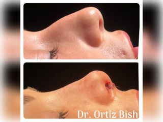 Antes y después rinoplastia - Dr Francisco Ortiz Bish