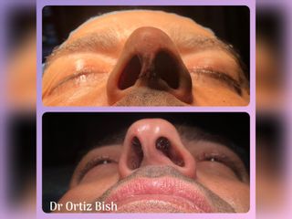 Antes y después rinoplastia - Dr Francisco Ortiz Bish