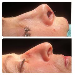 Rinoplastia - Dr Francisco Ortiz Bish