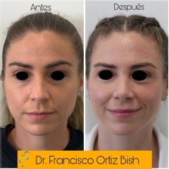 Rinoseptoplastia Frontal AD