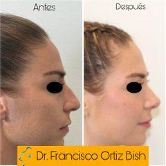 Dr Francisco Ortiz Bish - Rinoseptoplastia Perfil D AD