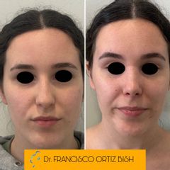 Dr Francisco Ortiz Bish - Rinoplastia Laura Frontal AD