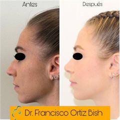 Dr Francisco Ortiz Bish - Rinoseptoplastia Perfil I AD