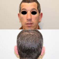 Dr Francisco Ortiz Bish - Otoplastia 9 Frontal Antes - otoplastia 9 Posterior Antes