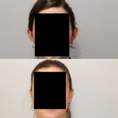 Dr Francisco Ortiz Bish - Otoplastia Frontal 1 A - Otoplastia Frontal 1 D