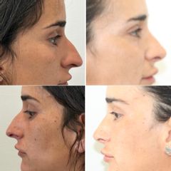 Dr Francisco Ortiz Bish - Rinoplastia