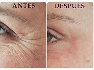 Antes y después rejuvenecimiento facial