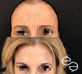 Eliminación de arrugas - Clinica Ésmèdic